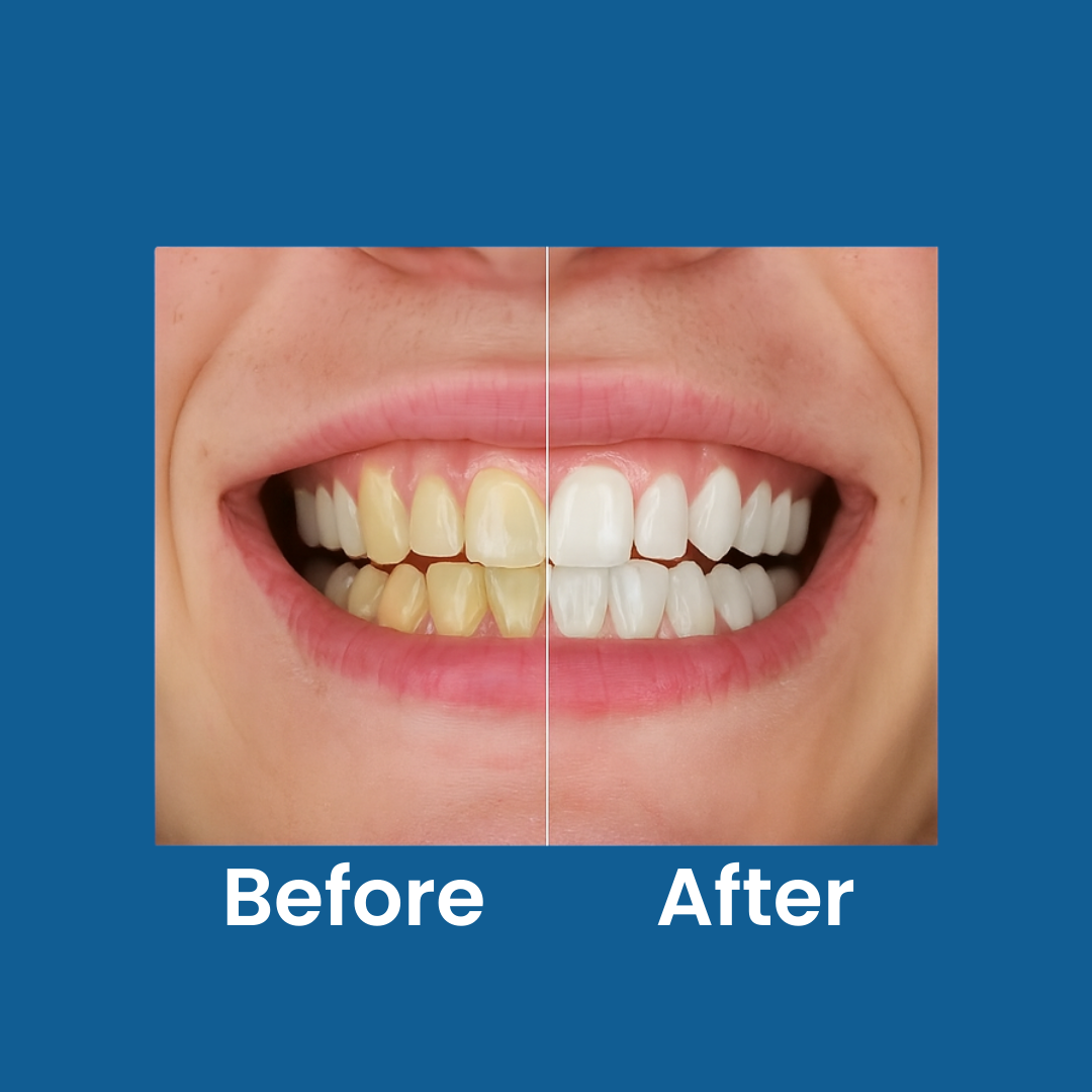 Teeth Whitening Serum Pen